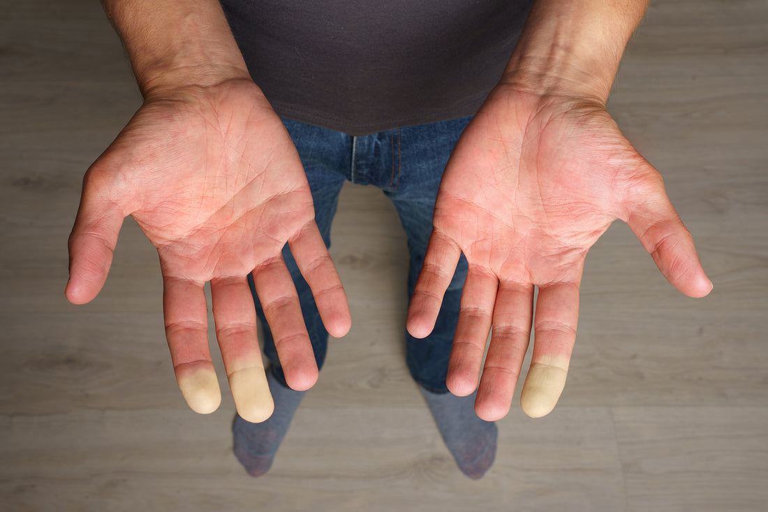 What Causes Raynaud's Disease